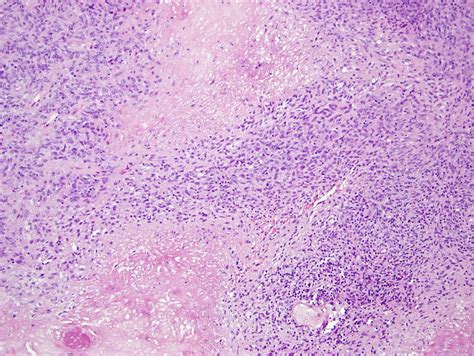 Dermatofibrosarcoma Protuberans Histology - OrthopaedicsOne Images