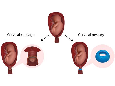 Cerclage: So funktioniert die Maßnahme gegen Frühgeburten