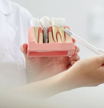 How An Implant Procedure? - Smilessence