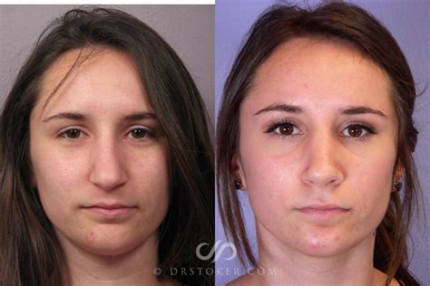 Septoplasty And Turbinate Reduction Before And After