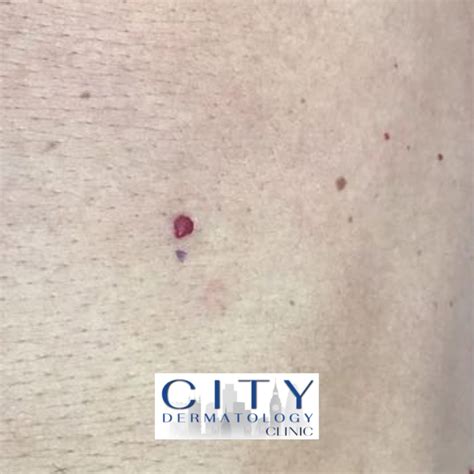 Cherry Angioma Removal in London from £275 | Same Day Treatment
