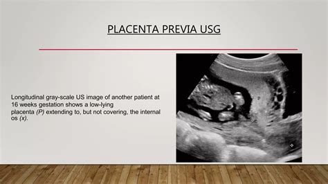 Placenta types and grading | PPTX