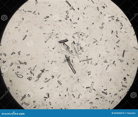 Amorphous Crystals In Human Urine at Carole Spears blog