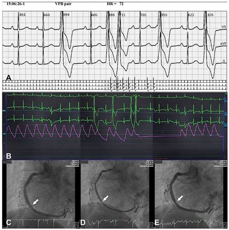 Coronary Artery Spasm-Related Heart Failure Syndrome: Literature Review
