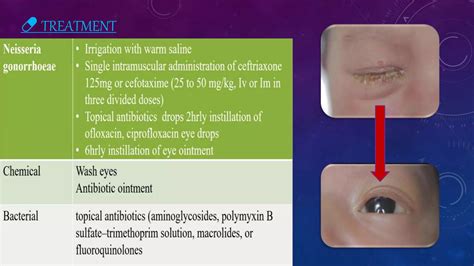 Ophthalmia Neonatorum/ Neonatal Conjunctivitis | PPTX
