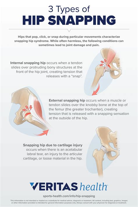 3 Types of Snapping Hip Syndrome Infographic
