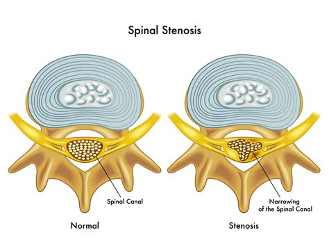 Icd10 Spinal Stenosis Lumbar