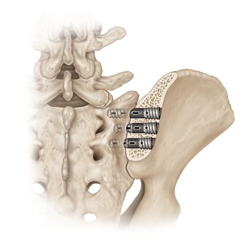 Surgery For Sacroiliac