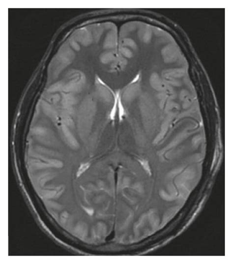 Image result for Median Filter Image Processing