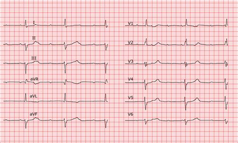[Cardio-FR] Complete A-V block. Escape rhythm with image of right bundle branch block and left ...