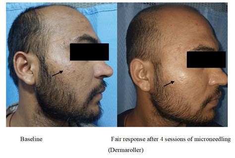Dermaroller Versus Platelet-Rich Plasma in Acne Scars. A Prospective ...