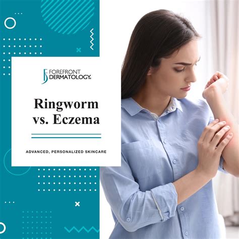 Nummular Eczema Vs Ringworm