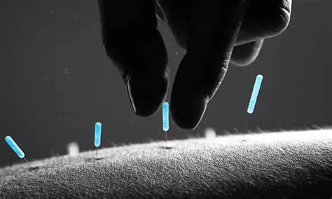 Acupuncture targets mast cells and inflammatory cascade to reduce ...