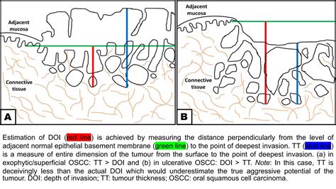8 th edition TNM classification and significance of depth of invasion | PPTX