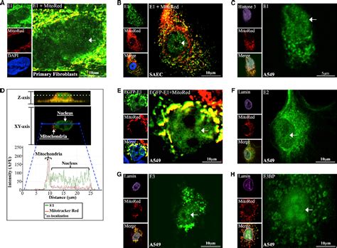 Image result for Pyruvate Dehydrogenase Complex Deficiency