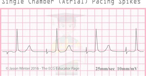 Image result for Pacemaker Programming