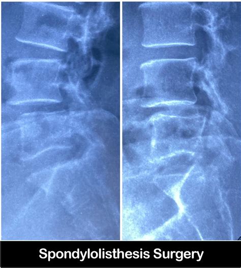 Best Spondylolisthesis Surgery in Faridabad