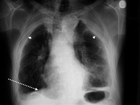 Diffuse pleural thickening and diaphragmatic paralysis causing combined ...