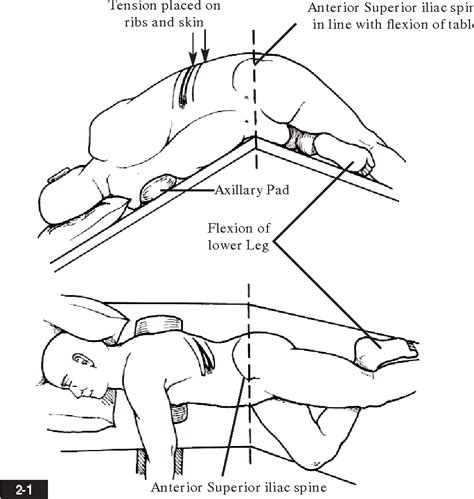 Image result for Flank Incision Nephrectomy
