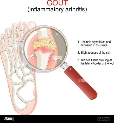 Gout. Close-up of joint with inflammatory arthritis. Humans foot with crystallization of uric ...