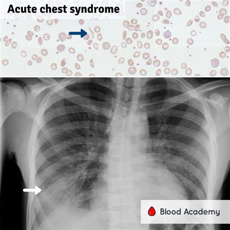 Acute Chest Syndrome (ACS) - Blood Academy