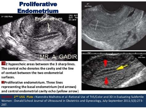Proliferative Phase Endometrium Ultrasound