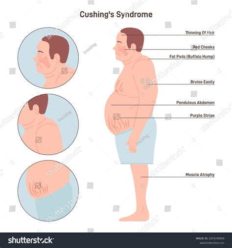 Cushing Syndrome Without Tumor at Evie Rounsevell blog
