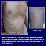 VEXIGO Pectus Excavatum Vacuum Bell, Pectus Excavatum India | Ubuy