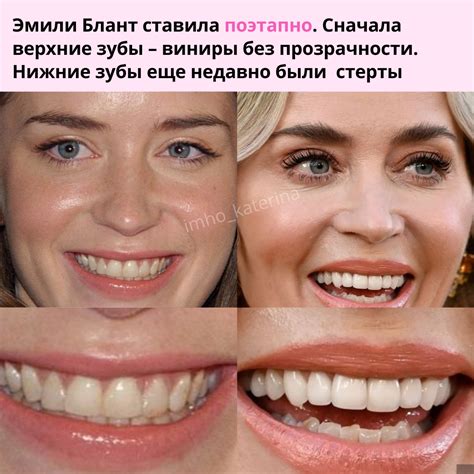 Виниры: что такое хорошо и что такое плохо — Teletype