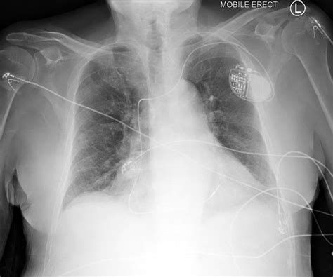 Chest X Ray Findings Pulmonary Edema at Sarah Bugarin blog