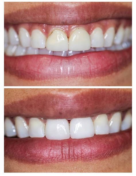 Cosmetic Dental Options: Porcelain Veneers Vs Crowns