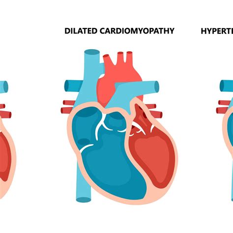 Leitlinie auf das gesamte Spektrum der Kardiomyopathien erweitert ...