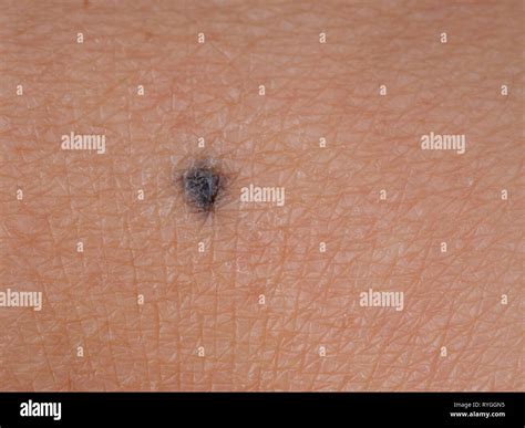 Skin cancer melanoma mole hi-res stock photography and images - Alamy