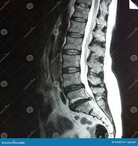 Mri Of Lumbar Spine Stenosis Stock Photo - Image: 52528178