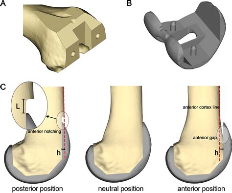 Appropriate sagittal positioning of femoral components in total knee arthroplasty to prevent ...
