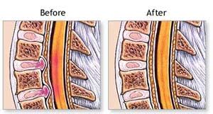 Spine Surgery: Spine Surgery