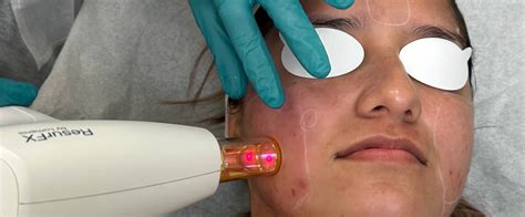 From Laser Treatment for Rosacea to Gentle Light: Building a Comprehensive Rosacea Treatment ...
