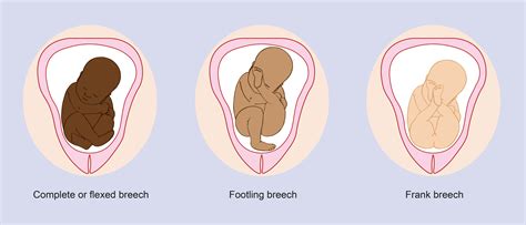 Breech pregnancy and safe birthing options | Pregnancy Birth and Baby