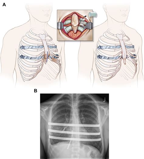 Success of Minimally Invasive Pectus Excavatum Procedures (Modified ...