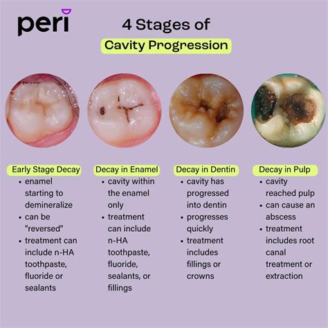 Signs Of A Cavity