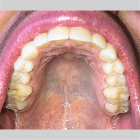 Roof Of Mouth Yellow Color