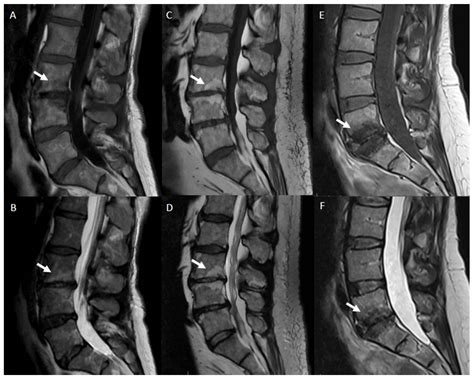 Degenerative Disc Disease of the Spine: From Anatomy to Pathophysiology and Radiological ...