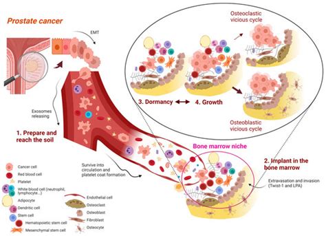 Bone Metastases and Health in Prostate Cancer: From Pathophysiology to ...