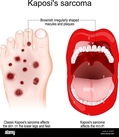 Kaposi's sarcoma High Resolution Stock Photography and Images - Alamy