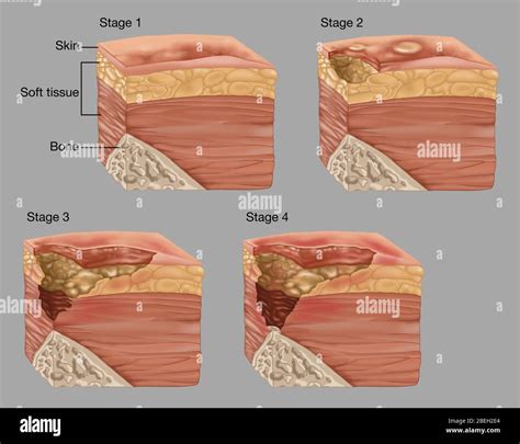 Pressure Sores High Resolution Stock Photography and Images - Alamy