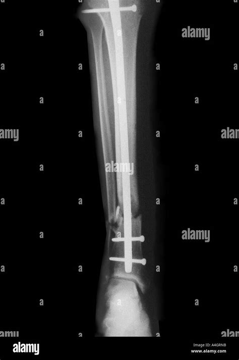 Intramedullary Nail Tibia 的图像结果