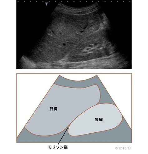 FASTのエコー像（モリソン窩） | 看護roo![カンゴルー]