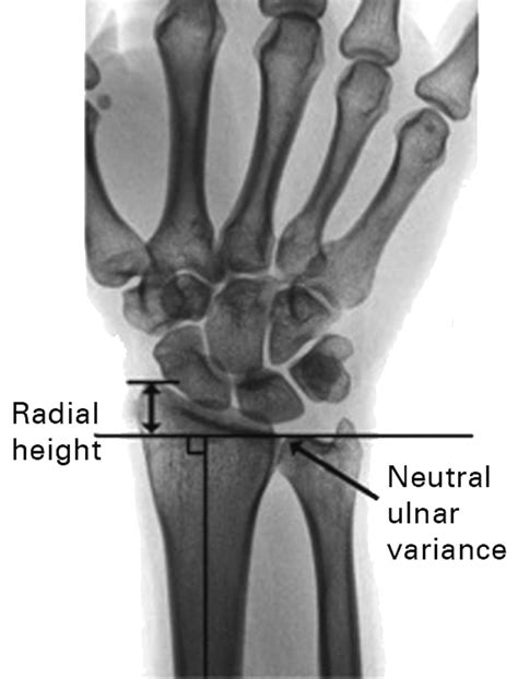 Are radiographic measurements of the displacement of a distal radial fracture reliable and ...