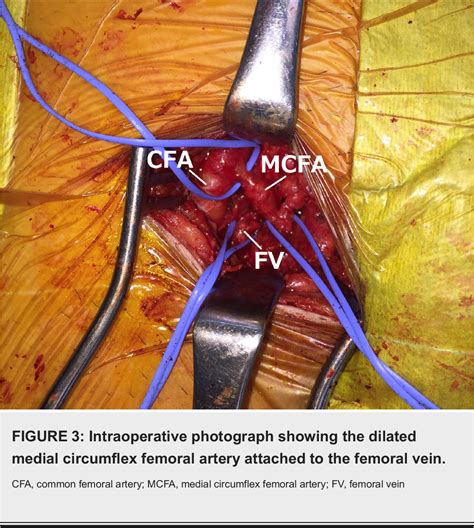 Figure 3 from An Unusual Variational Anatomy of the Medial Circumflex ...