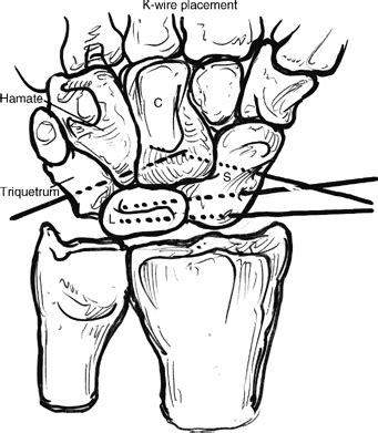 Image result for Lunate Dislocation Reduction